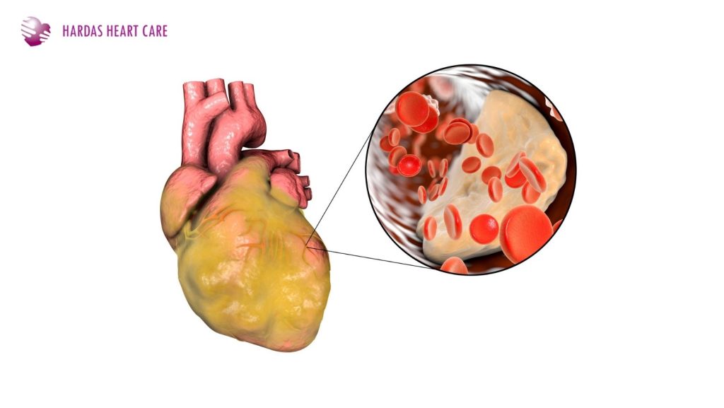 Learn about coronary artery disease, its causes, symptoms, and treatment with expert insights from Dr. Suhas Hardas, Pune’s leading cardiologist.