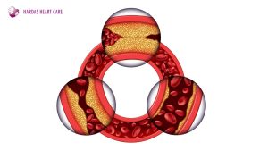 why cholesterol is bad for your heart heart - explained by Top cardiologist Dr. Suhas Hardas