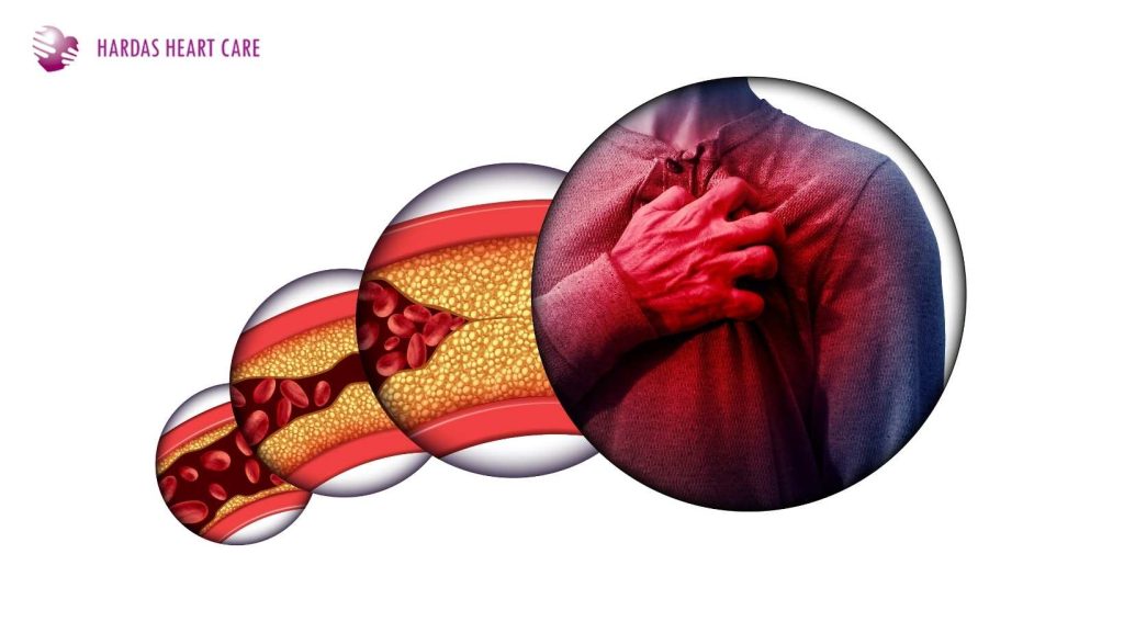 How Cholesterol Is Linked to Heart Disease