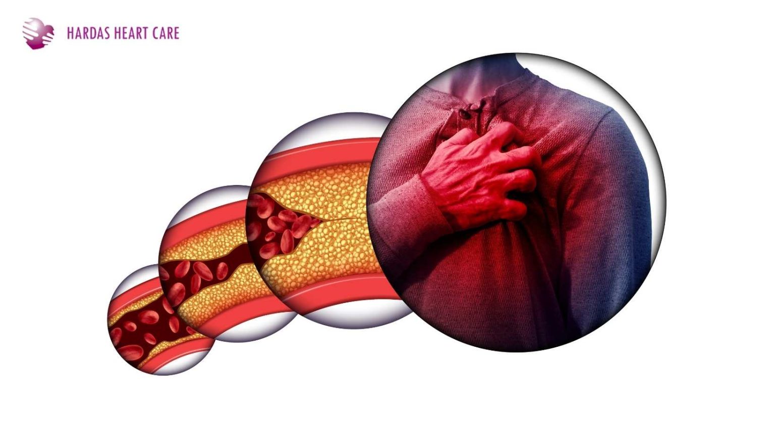 How Cholesterol Is Linked to Heart Disease