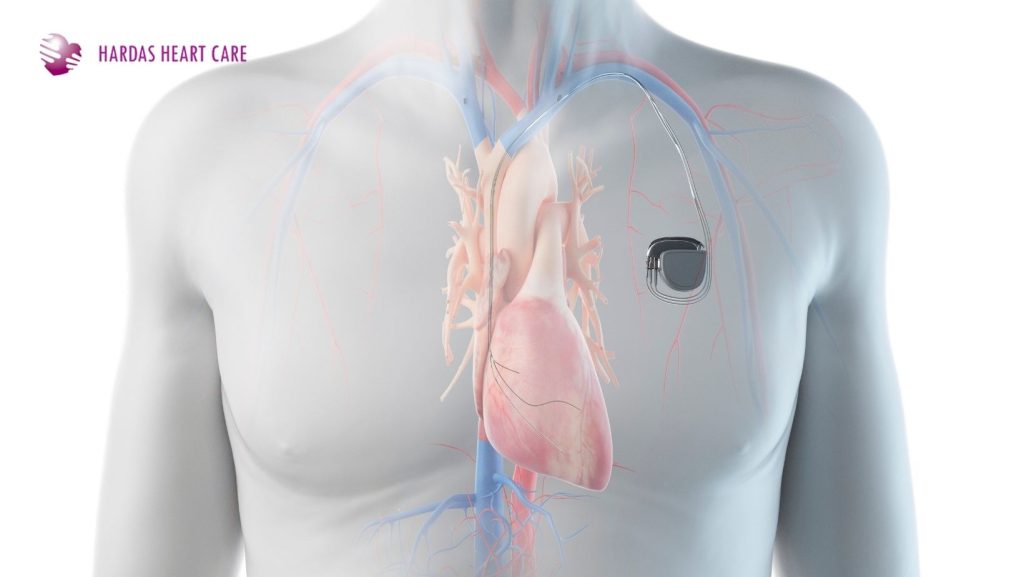 Human body anatomical graphic showing pacemaker implanted in chest to regulate heart rhythm