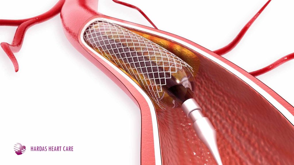 Illustration of angioplasty showing a balloon catheter expanding a stent inside a blocked coronary artery next to an anatomical heart diagram.